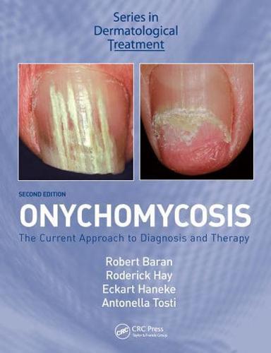 Onychomycosis By:Antonella Tosti Eur:351.20 Ден1:3099